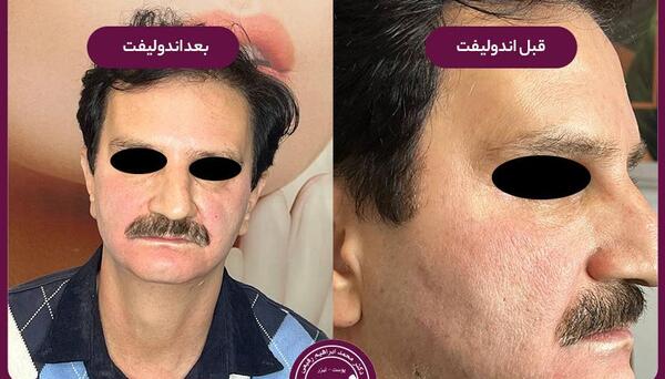 عکس قبل و بعد اندولیفت