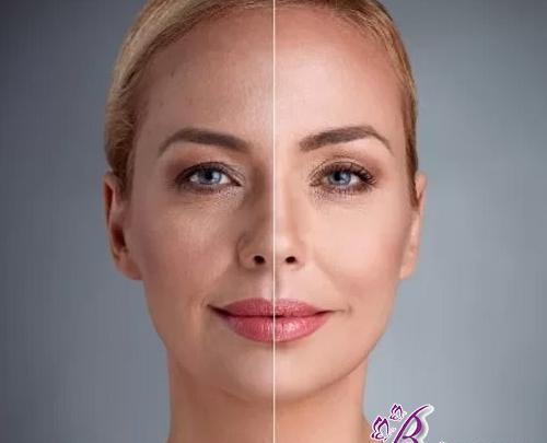 عکس قبل و بعد اندولیفت