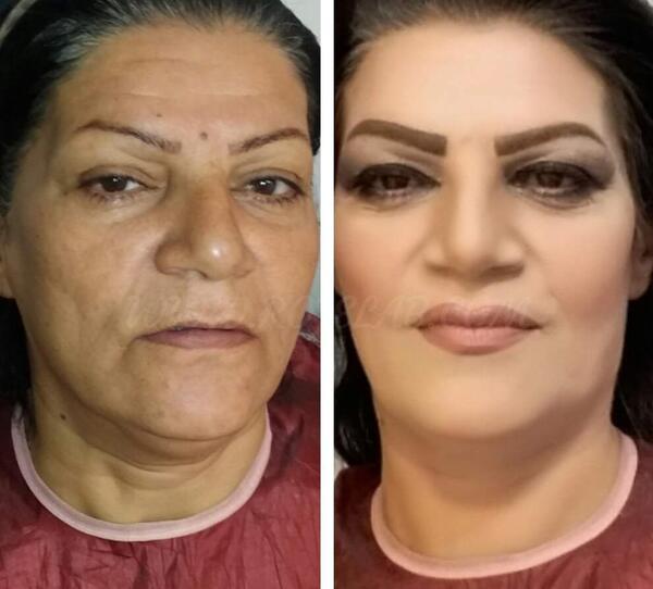 عکس قبل و بعد اندولیفت