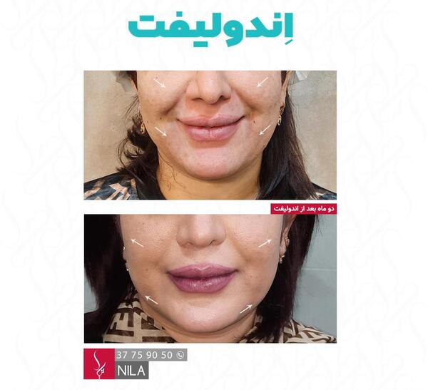 عکس قبل و بعد اندولیفت