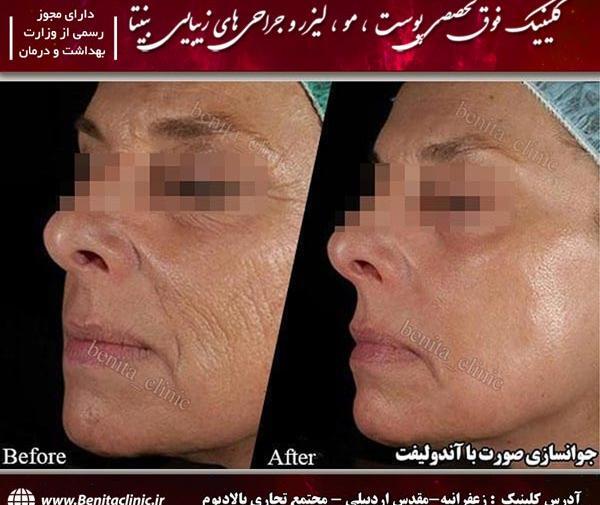 عکس قبل و بعد اندولیفت