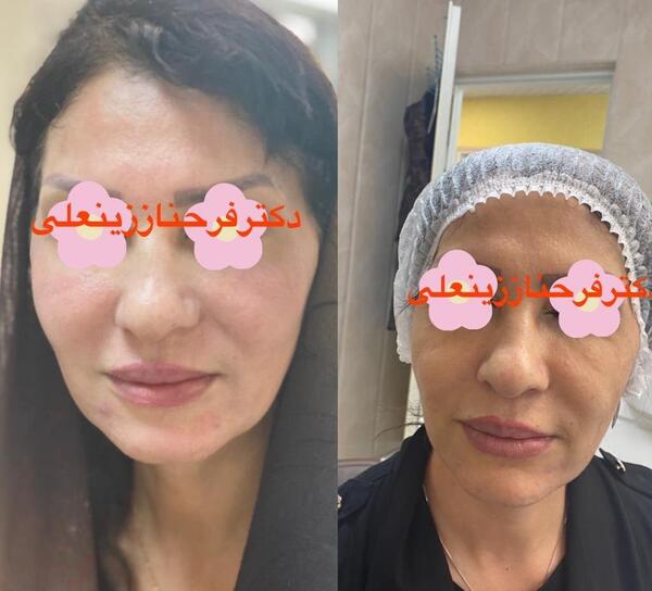 عکس قبل و بعد اندولیفت