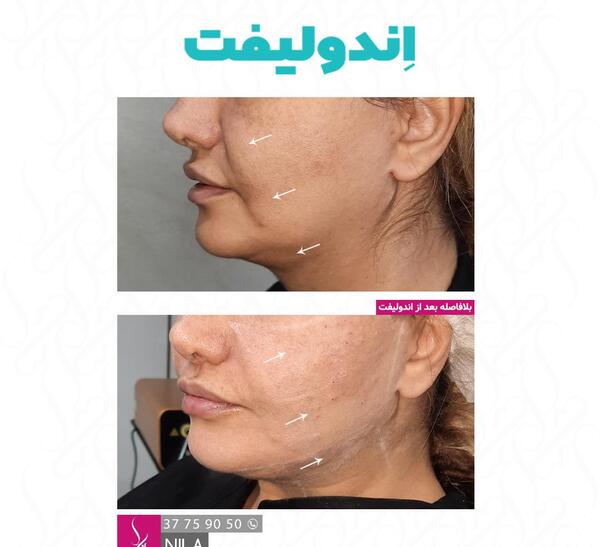 عکس قبل و بعد اندولیفت