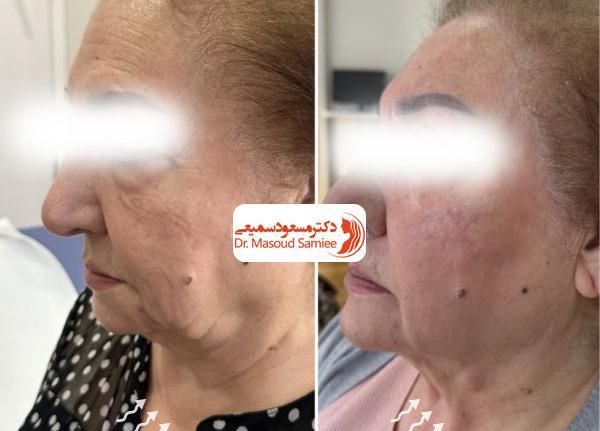 عکس قبل و بعد اندولیفت