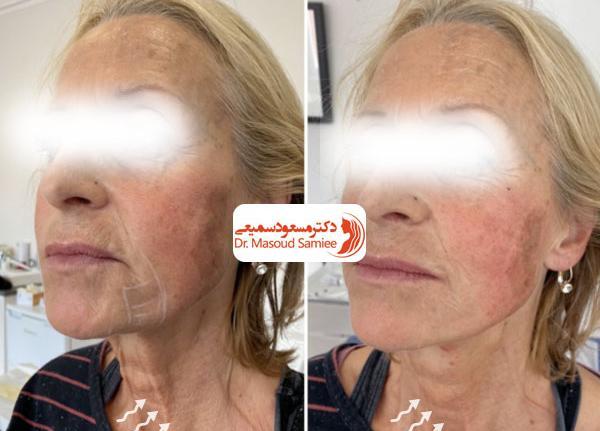 عکس قبل و بعد اندولیفت