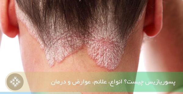 عکس بیماری پسوریازیس