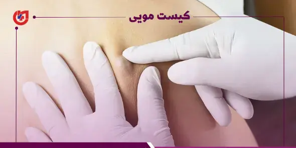 عکس کیست مویی در مراحل اولیه