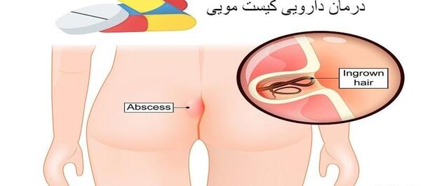عکس کیست مویی در مراحل اولیه