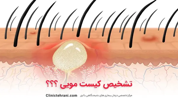عکس کیست مویی در مراحل اولیه