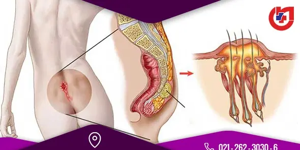 عکس کیست مویی در مراحل اولیه