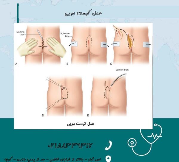 عکس کیست مویی در مراحل اولیه