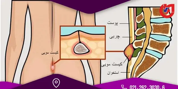 عکس کیست مویی در مراحل اولیه
