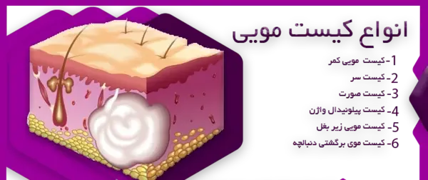 عکس کیست مویی در مراحل اولیه