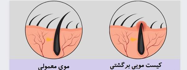 عکس کیست مویی در مراحل اولیه