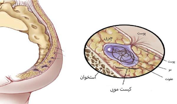 عکس کیست مویی در مراحل اولیه