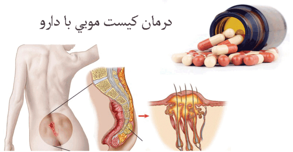 عکس کیست مویی در مراحل اولیه