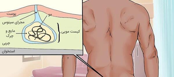 عکس کیست مویی در مراحل اولیه