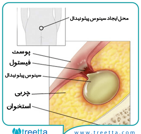 عکس کیست مویی در مراحل اولیه