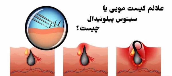 عکس کیست مویی در مراحل اولیه
