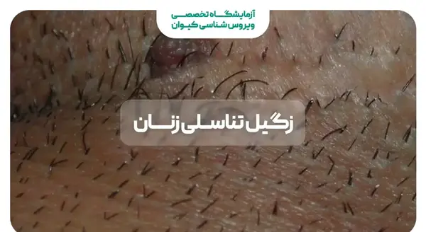 عکس از انواع زگیل