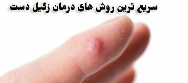 عکس از انواع زگیل