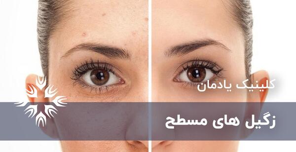 عکس انواع زگیل معمولی