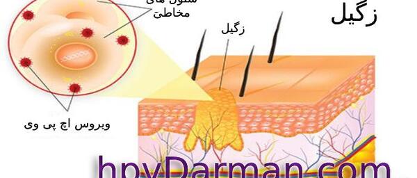 عکس انواع زگیل معمولی