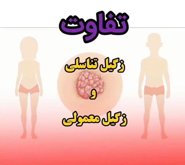 عکس انواع زگیل معمولی