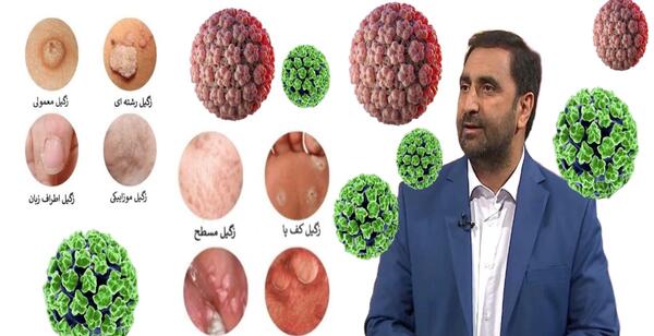 عکس انواع زگیل معمولی
