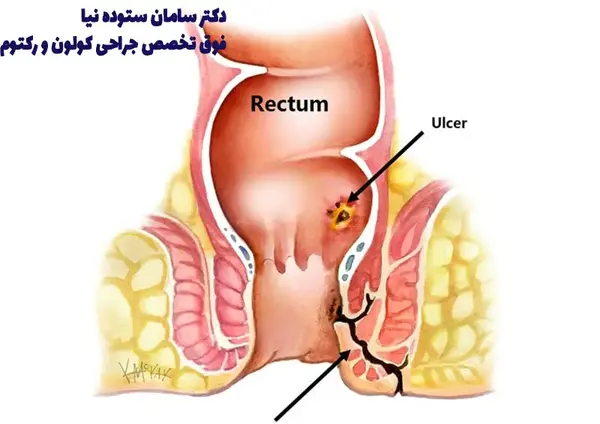 عکس عفونت مقعدی