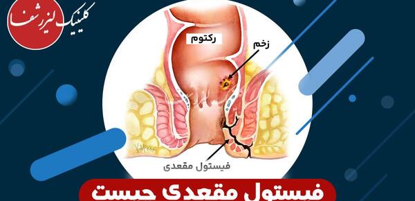 عکس عفونت مقعدی