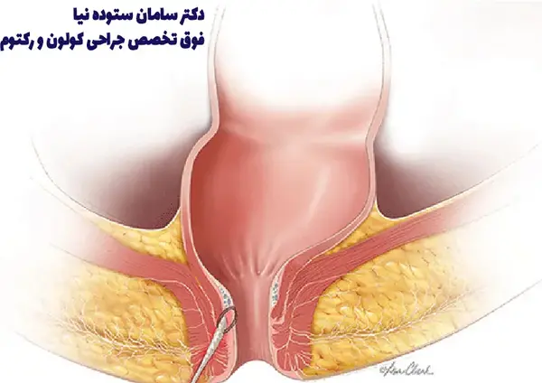 عکس عفونت مقعدی