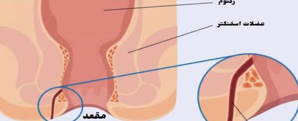 عکس عفونت مقعدی