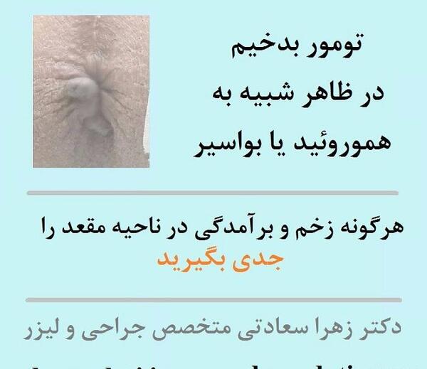 عکس عفونت مقعدی