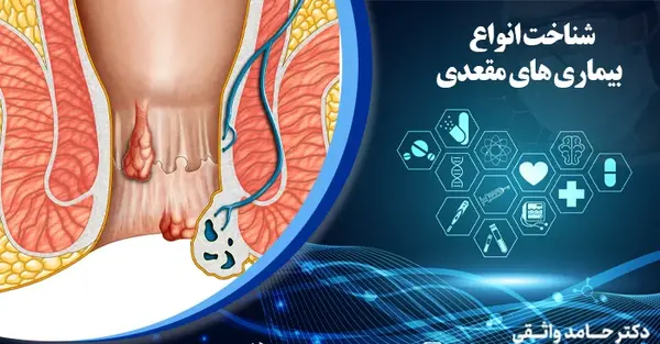 عکس عفونت مقعدی