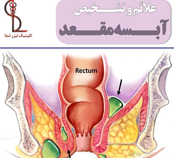 عکس عفونت مقعدی