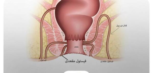 عکس عفونت مقعدی