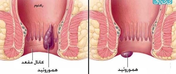 عکس عفونت مقعدی
