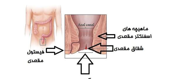 عکس عفونت مقعدی