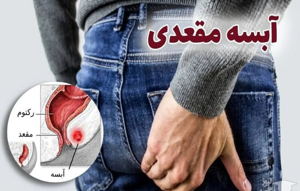 عکس عفونت مقعدی