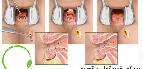 عکس عفونت مقعدی