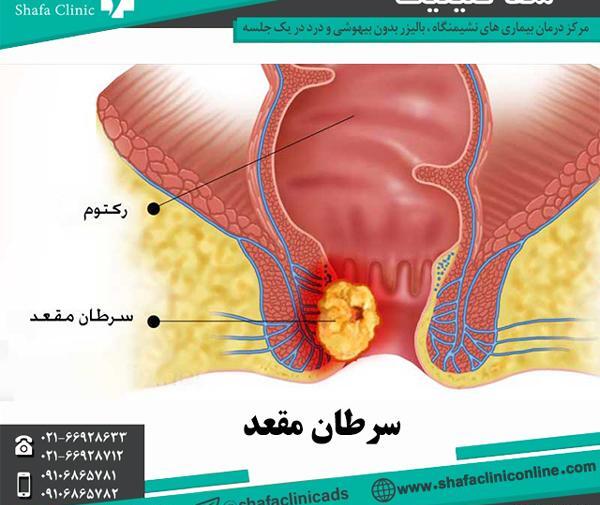 عکس عفونت مقعدی