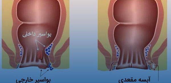 عکس عفونت مقعدی