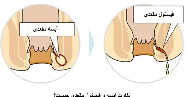 عکس عفونت مقعدی