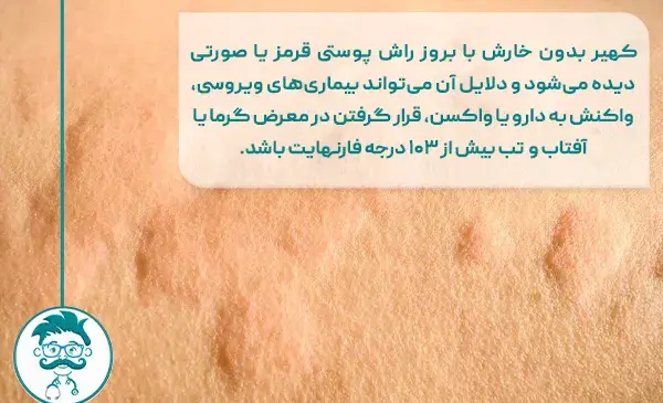 عکس کهیر پوستی
