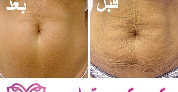 عکس قبل و بعد کربوکسی تراپی
