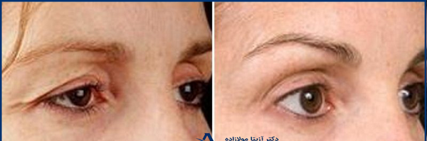 عکس قبل و بعد کربوکسی تراپی