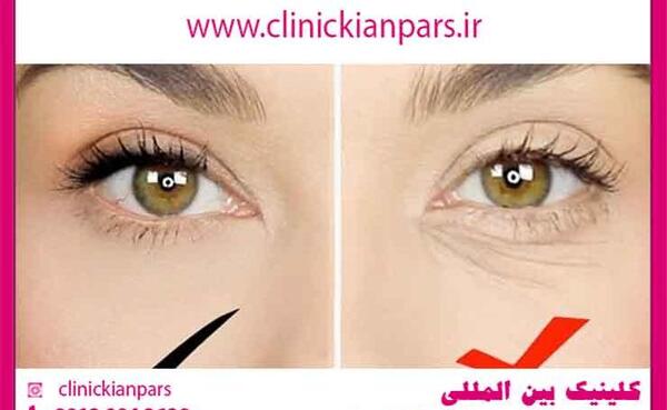عکس قبل و بعد کربوکسی تراپی
