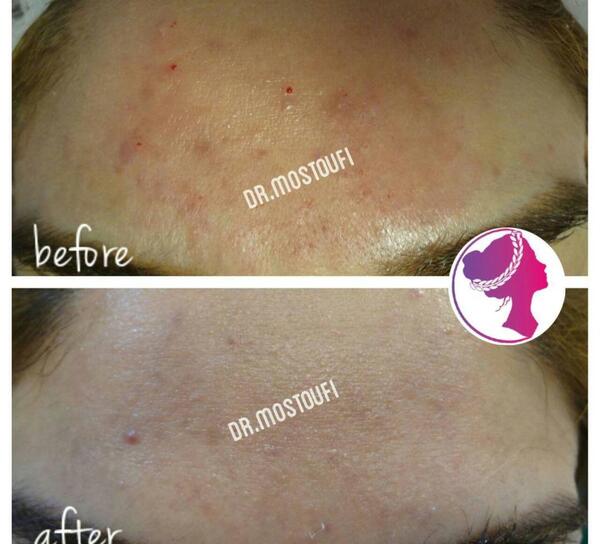 عکس قبل و بعد کربوکسی تراپی