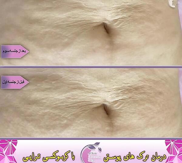 عکس قبل و بعد کربوکسی تراپی